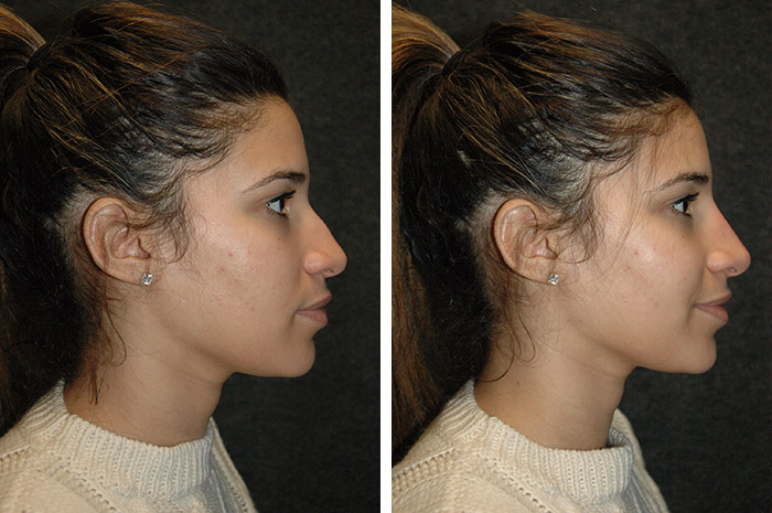 non surgical nose job