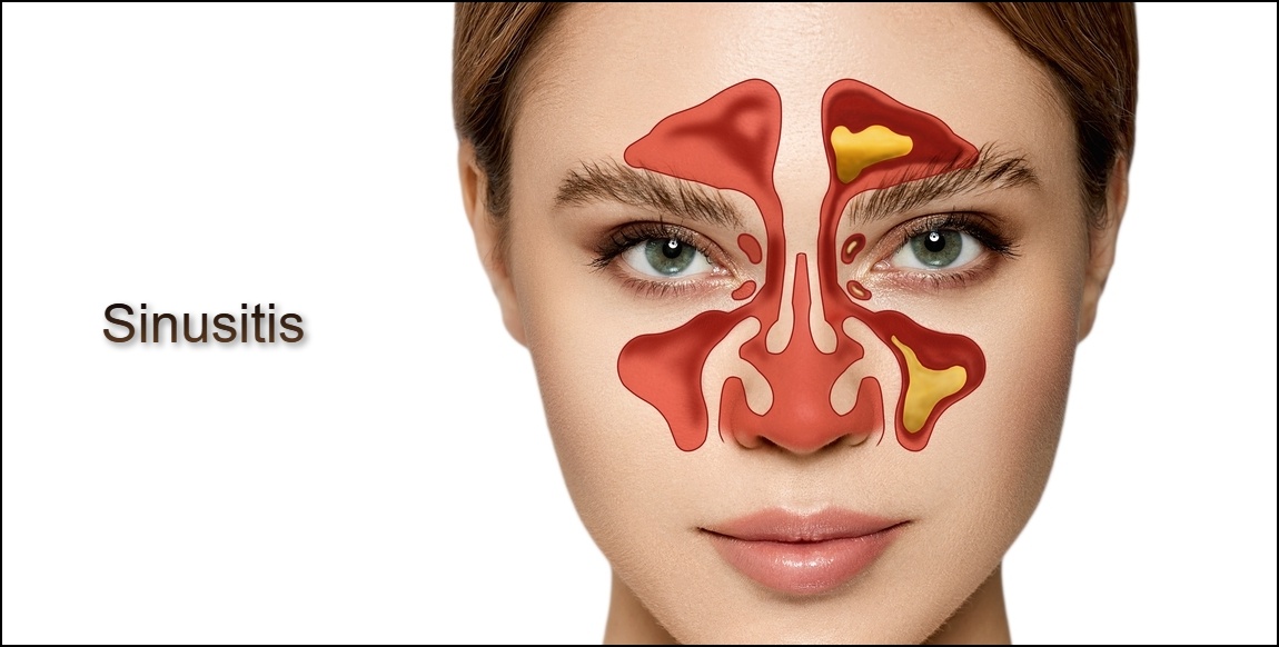 Sinus Treatment in Aurora