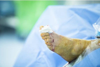 Why Choose Foot And Ankle Center Of Arizona For Matrixectomy Procedures